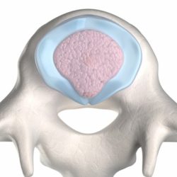 Cpt for lysis of adhesions