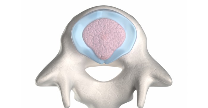 Cpt for lysis of adhesions