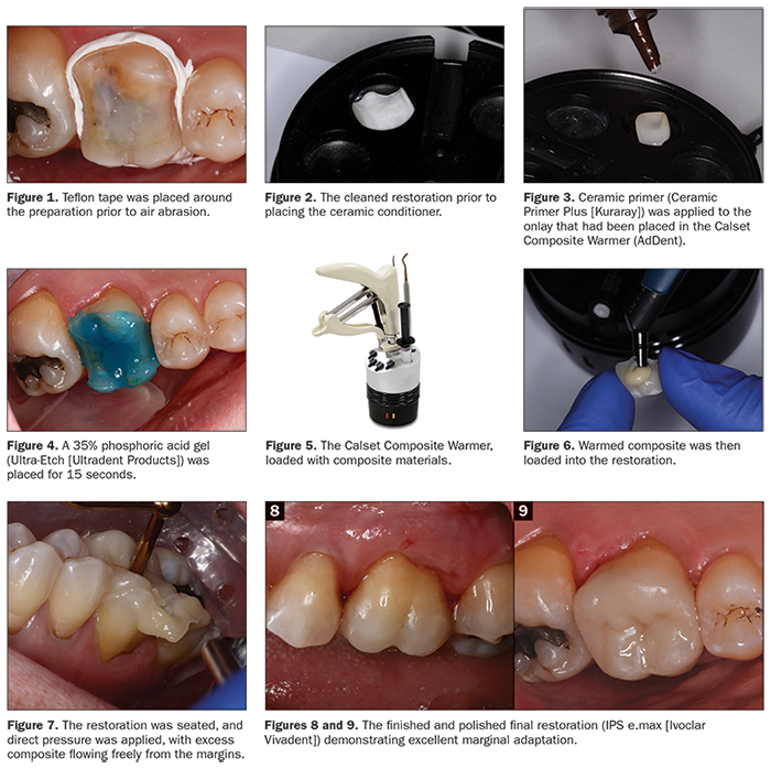 Composite posterior restorations direct dentistry