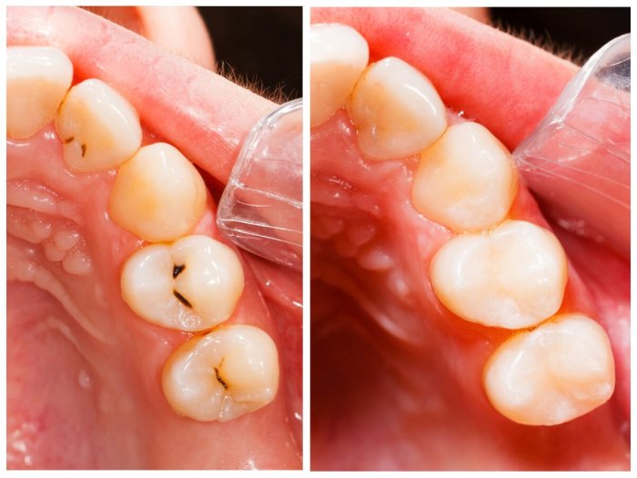 Resin based composite three surfaces posterior